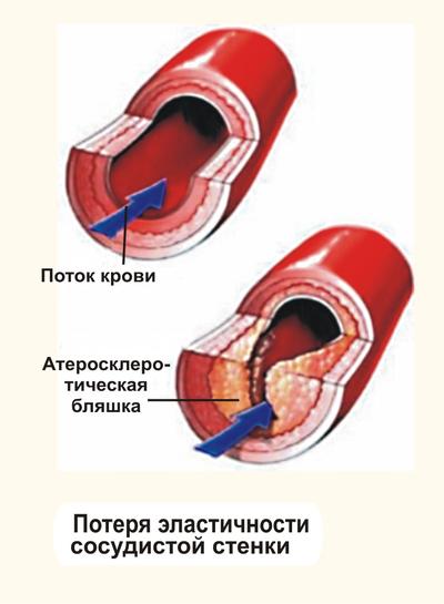 Obezitatea și sistemul cardiovascular