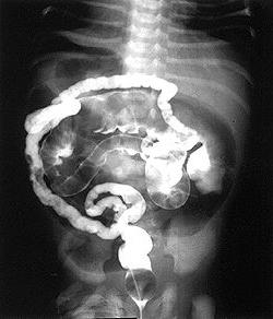 Pareza intestinului sau ileus