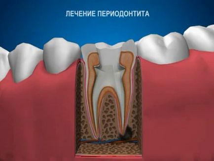 періодонтит зуба