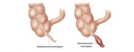 Primele semne și simptome de apendicită la bărbați, din care parte este, așa cum se manifestă