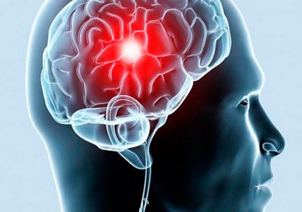 Primele semne și simptome de accident vascular cerebral la femei