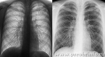 Перші ознаки туберкульозу у чоловіків, симптоми і ознаки легеневого і позалегеневого туберкульозу,