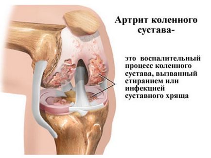 De ce tratamentul și prevenirea durerii genunchiului
