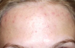 De ce există cosuri și acnee cauze de acnee