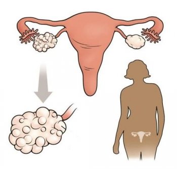 Полікістоз яєчників - лікування, симптоми, причини