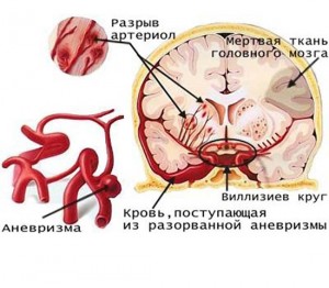 Consecințele accidentului vascular cerebral, tratamentul consecințelor ischemice, accident vascular cerebral hemoragic