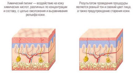 Lipirea superficială a feței, efectuată, recenzii, contraindicații, îngrijire ulterioară