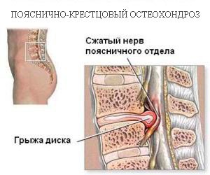 Simptome osteochondrozei lombosacrale, tratament