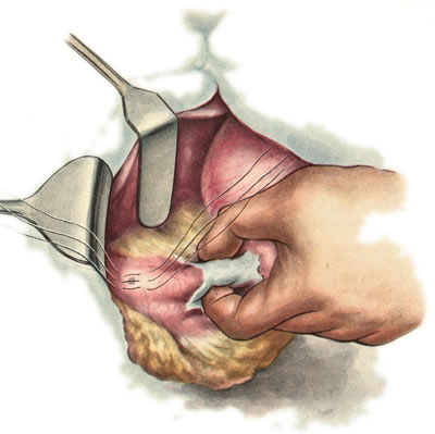 Ulcer perforat (perforație, perforare) a stomacului, duoden