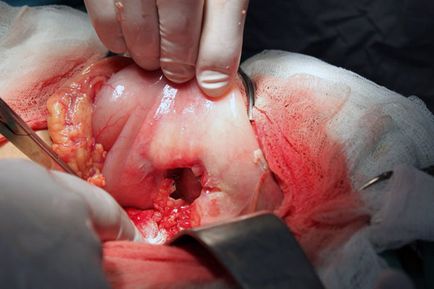 Ulcer perforat (perforație, perforare) a stomacului, duoden