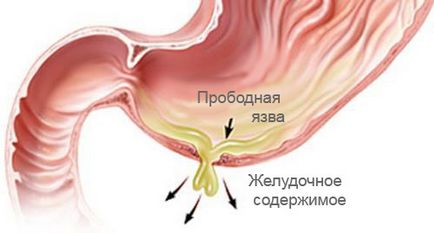 Ulcer perforat (perforație, perforare) a stomacului, duoden