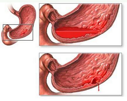 Ulcer perforat (perforație, perforare) a stomacului, duoden