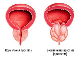 Mod relaxant pentru a preveni adenomul prostatic