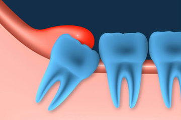 Ріжеться зуб мудрості, болить ясна - чим знеболити