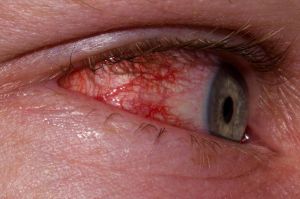 Simptome oftalmice simpatice, diagnostic, tratament