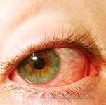 Simptome oftalmice simpatice, tratament, prevenire