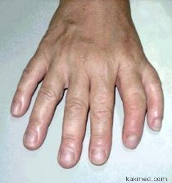 Sindromul apera (sindromul) Sindromul apare