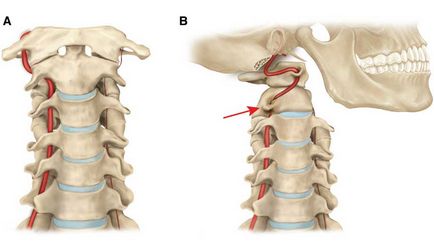 Sindromul arterei vertebrale și tratamentul acesteia