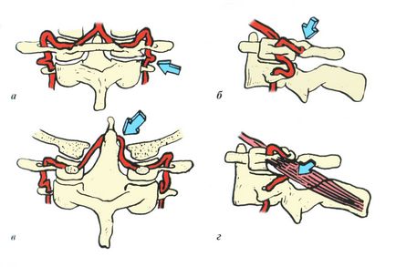 Sindromul arterei vertebrale și tratamentul acesteia