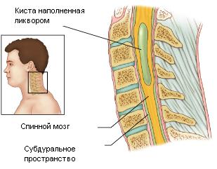 Syringomyelia, centrul pula
