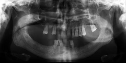 Implanturi de piept - dottor mingione - studio dentistico pesaro