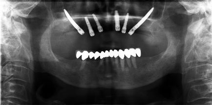 Járomcsonti implantátumok - Dottor mingione - stúdió dentistico Pesaro (pofa) Járomcsonti implantátumok - Dottor mingione - stúdió dentistico Pesaro