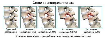 Deplasarea vertebrelor toracice, simptome, tratament