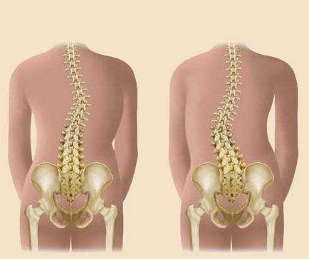 Deplasarea vertebrelor toracice, simptome, tratament