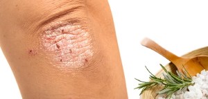 Holt-tengeri só egészséges psoriasis