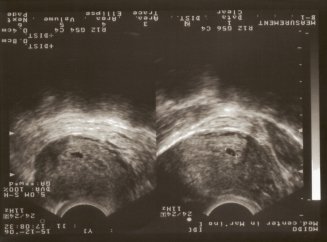 Terhességi kor 2 hét az embrió és a fejlesztési