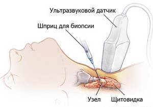 Tehnica efectuării biopsiei fine a acului și dacă afectează glanda tiroidă