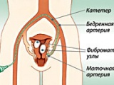 Tikhomirov alexander leonidovich poate fi vindecat de miomul uterului!