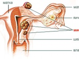 Тихомиров олександр леонидович міому матки вилікувати можливо!