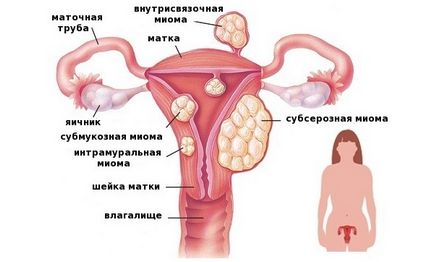 Тихомиров на миома на матката заболяване