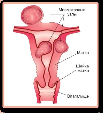 Tikhomirov privind boala miomului uterin