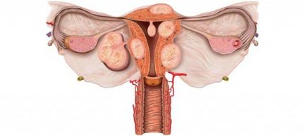 Тихомиров на миома на матката заболяване