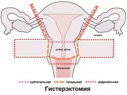 Tikhomirov privind boala miomului uterin