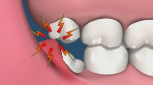 Intelegerea dintelui intelepcios este tot pentru si impotriva - bloguri - portal medical - clinici, medicamente, medici,