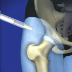 Injecții în articulația șoldului cu coxartroză