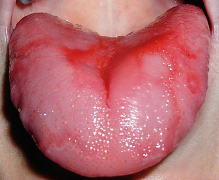 A gyermek a nyelv a piros folt, mint az égési (kép, diagnózis, kezelés, és ok)