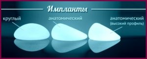 Збільшення грудей анатомічними имплантами їх гідності