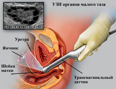 Узі органів малого таза, що може показати