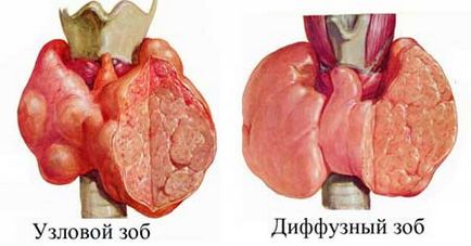 Simptomele și tratamentul nodurilor tiroidiene