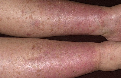 Dermatita varicoasă a fotografiei pentru tratamentul extremităților inferioare