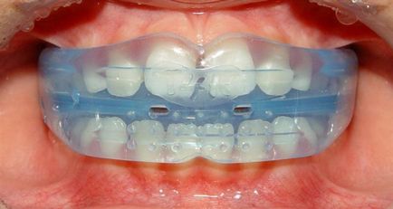 Îndreptarea dinților - metode de îndreptare a dinților