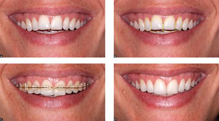Egalarea dinților în metodele de adulți, preț, ghidul dentar
