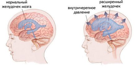 Tensiunea intracraniană la adulții tratați cu medicamente populare