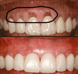 Запалення кореня зуба лікування складних випадків