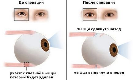 Tratamentul chirurgical al strabismului