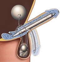 Chirurgie pentru impotență, faloprotetică, restaurarea arterelor, implanturi masculine